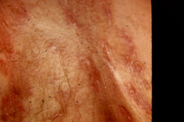 Pemphigus Foliaceus (23)