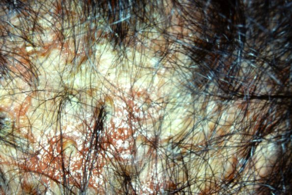 Pemphigus Garagozio