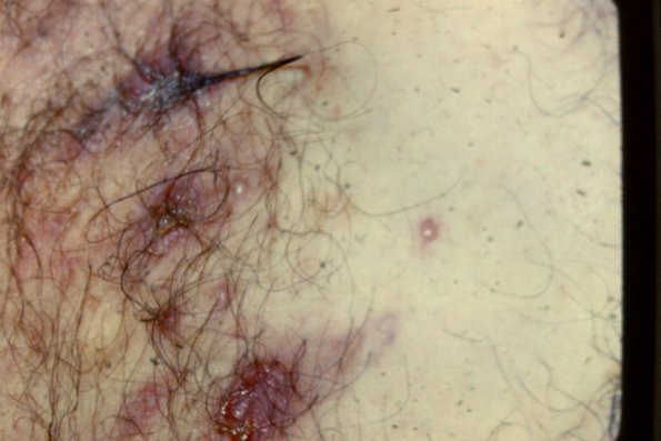 Pemphigus Vulgaris (23)