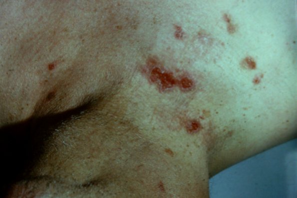 Pemphigus Vulgaris (4)