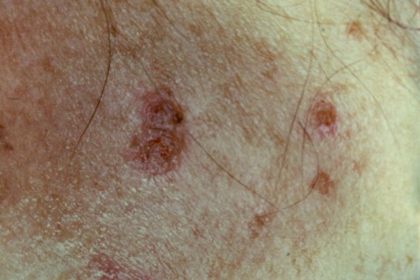 Pemphigus Vulgaris (8)
