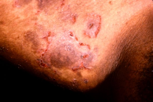 Pemphigus Vulgaris