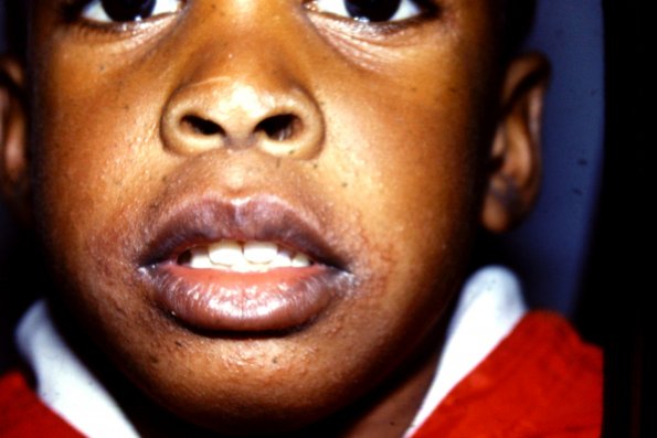 Perioral Dermatitis