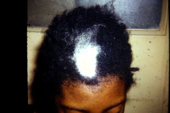 Acquired Poliosis