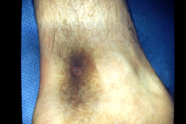 Schambergs Disease