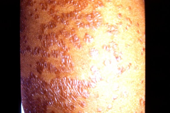 Pityriasis Rubra Pilaris (2)