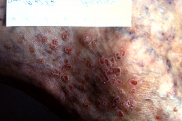 Pocokeratosis Mibelli