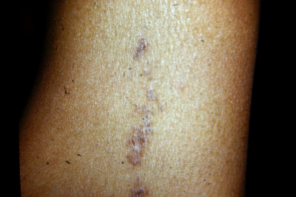 Linear Prokeratosis (4)