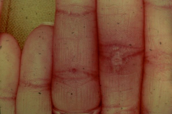 Palmar Porokeratosis