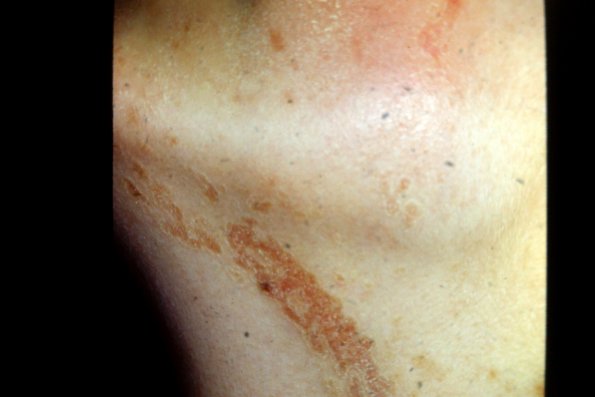 Porokeratosis (2)