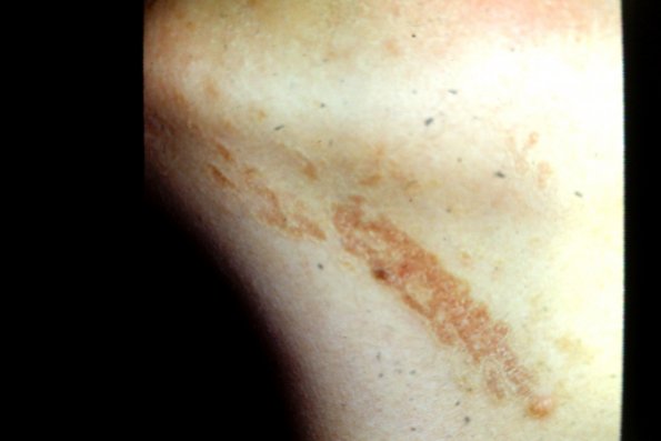 Porokeratosis (3)