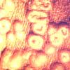 Smallpox (2)