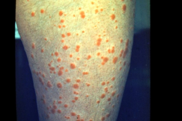 Guttate Psoriasis (13)