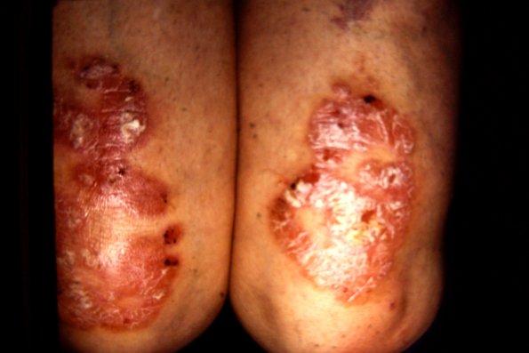 Psoriasis (66)