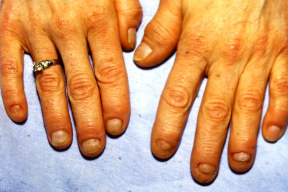 Psoriatic Arthritis