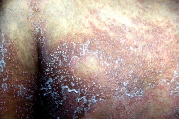 Pustular Psoriasis (37)