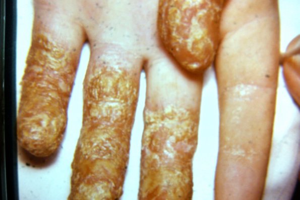 Pustular Psoriasis (6)