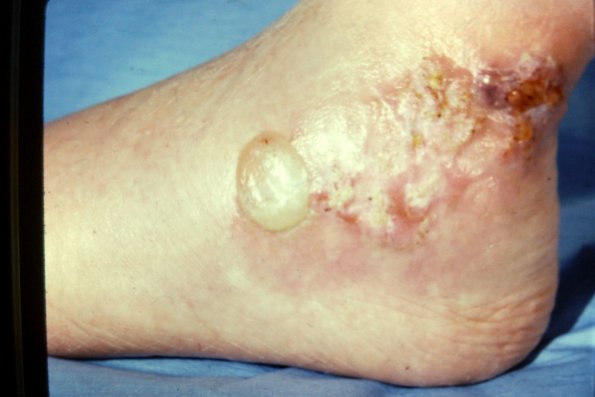 Bullous Pyoderma (2)