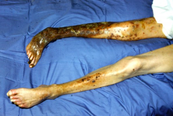 Mycosis-Like Pyoderma