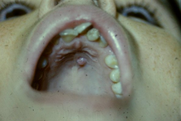 Pyogenic Granuloma (2)