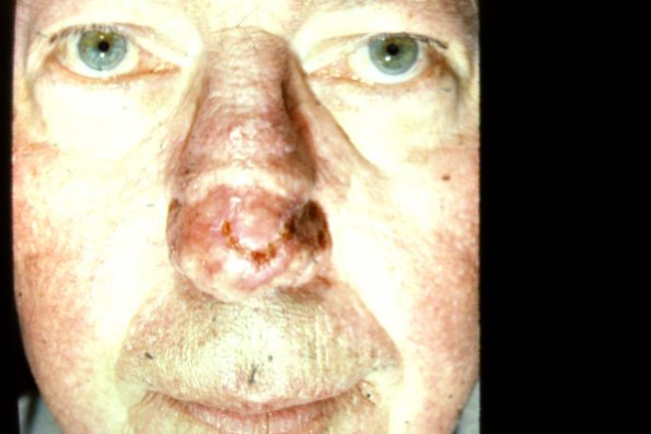 Rhinophyma (7)