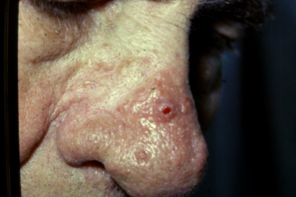 Rhinophyma