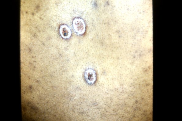 Granuloma Sarcoidosis +lues