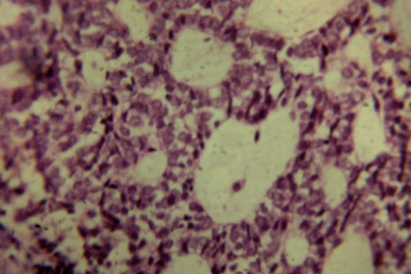 Squaroid Sarcoma (3)