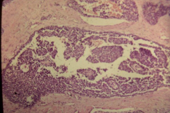 Squaroid Sarcoma