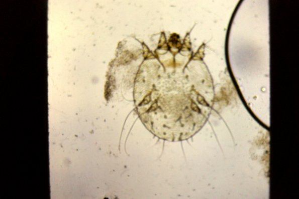 Accarus Scabies (2)