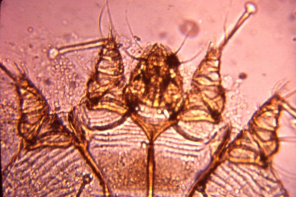 Accarus Scabies