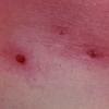 Scabies (2)