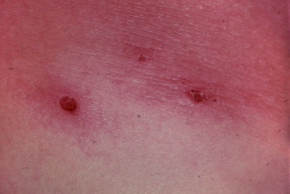 Scabies (2)