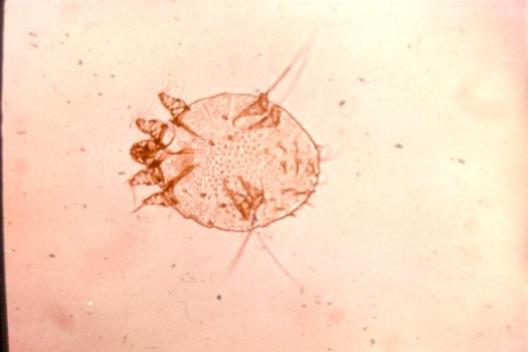 Scabies (4)