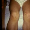Scabies (5)