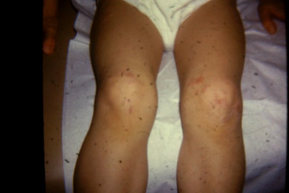 Scabies (5)