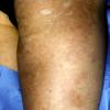 Scleroderma (40)