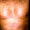 Scleroderma (46)