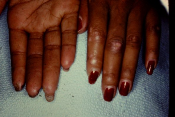 Scleroderma (6)