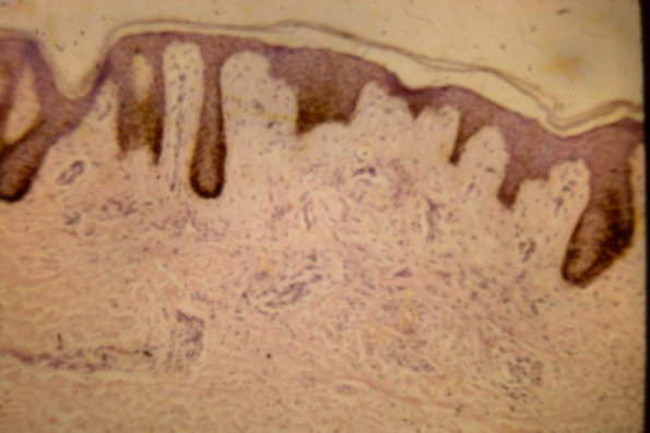 Scleromyxedema (13)