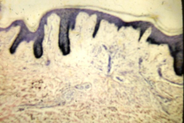 Scleromyxedema (17)