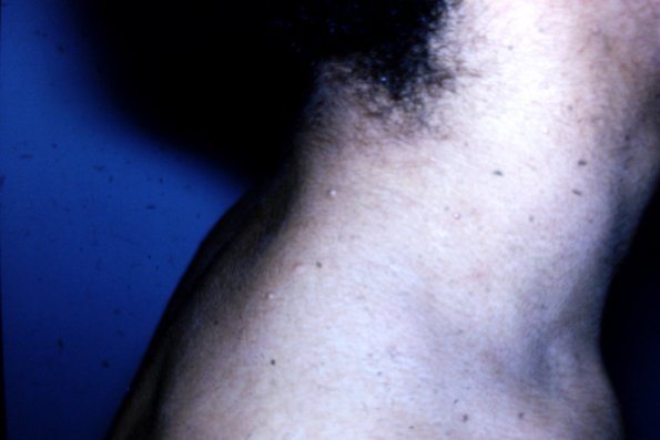 Scleromyxedema (20)