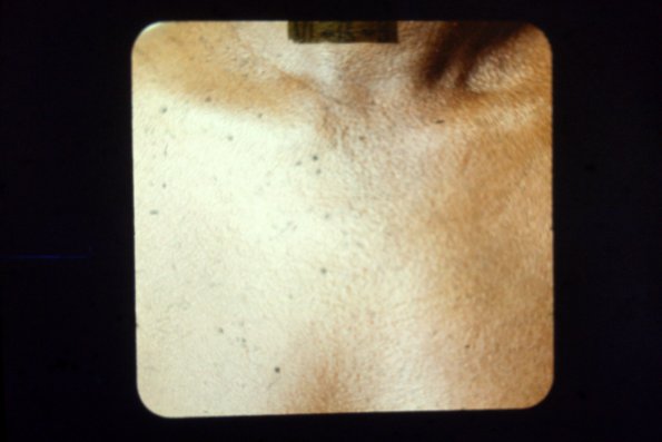 Scleromyxedema (32)