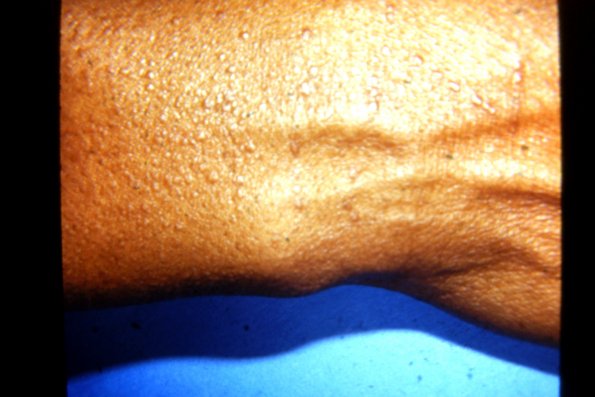 Scleromyxedema (8)