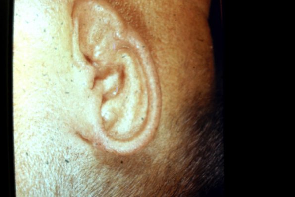 Scleromyxedema (9)