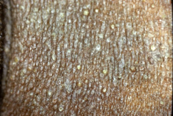 Popular Seborrheic Dermatitis