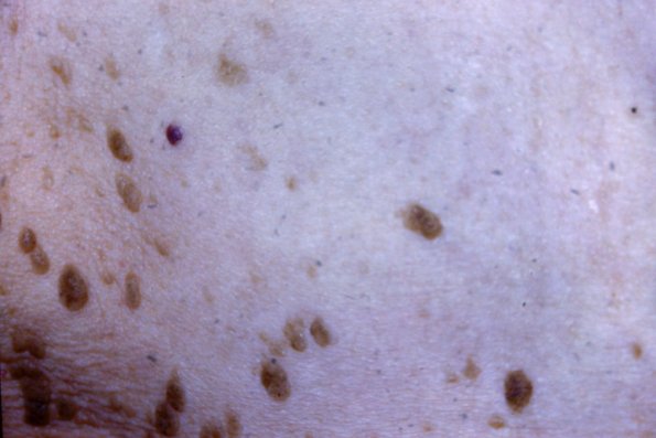 Seborrheic Kenatoses