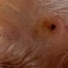 Seborrheic Keratosis (3)