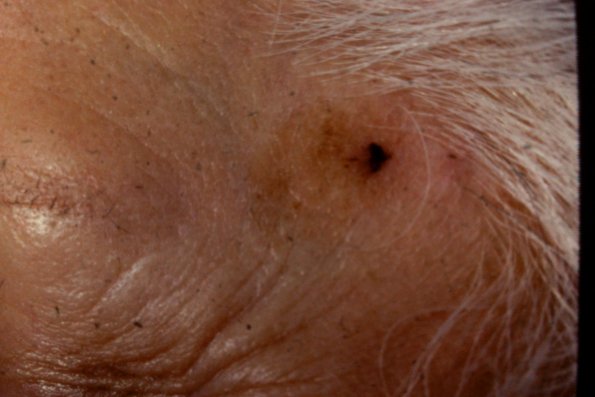 Seborrheic Keratosis (3)