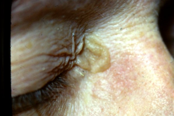 Seborrheic Keratosis